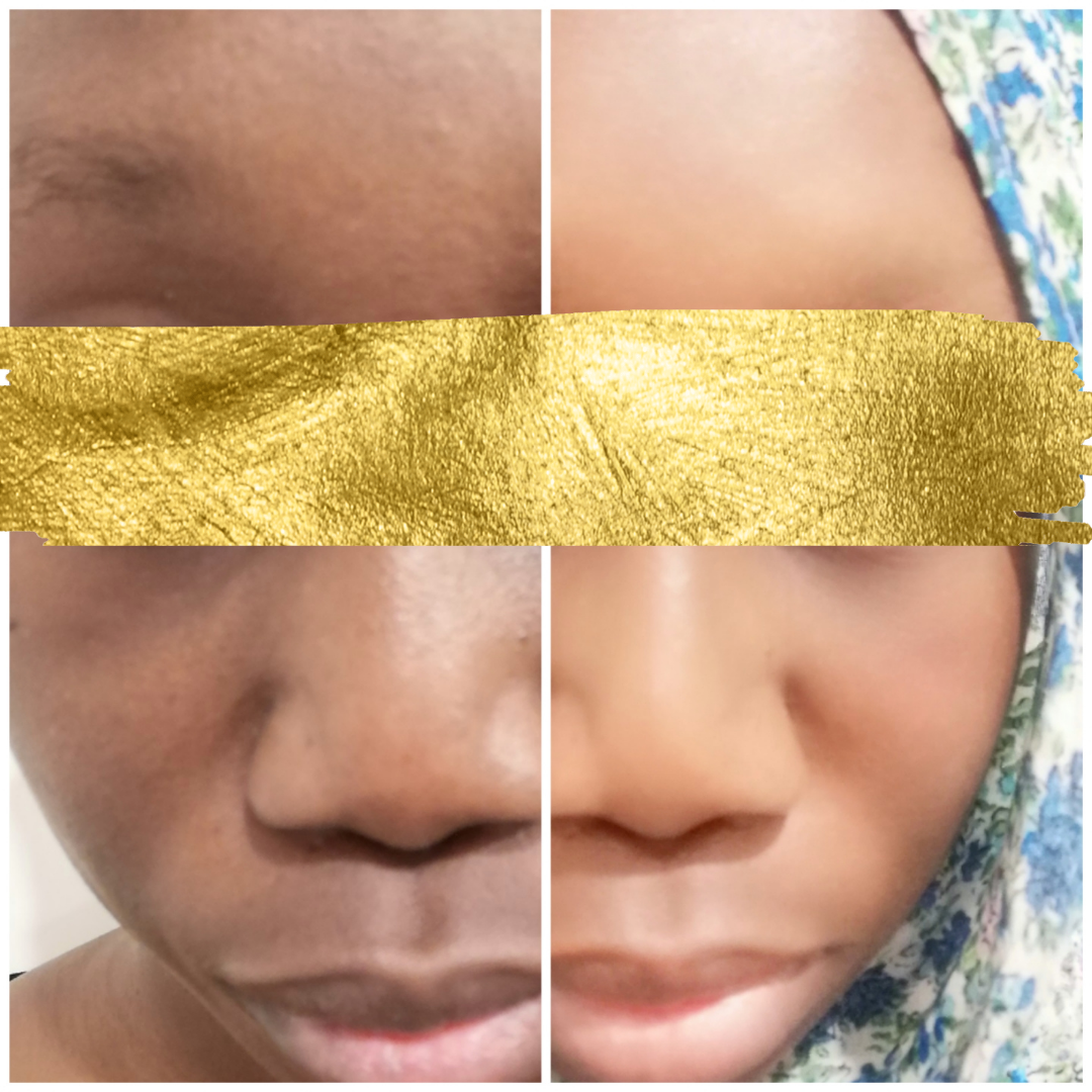 cosmetique peau noire
beau teint
hyperpigmentation
hyperpigmentation peau noire
tâche hyperpigmentation
hyperpigmentation visage
skincare
serum anti tache
serum anti imperfection
serum anti age
serum vitamine C