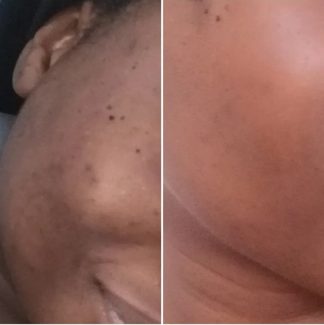 cosmetique peau noire
beau teint
hyperpigmentation
hyperpigmentation peau noire
tâche hyperpigmentation
hyperpigmentation visage
skincare
serum anti tache
serum anti imperfection
serum anti age
serum vitamine C