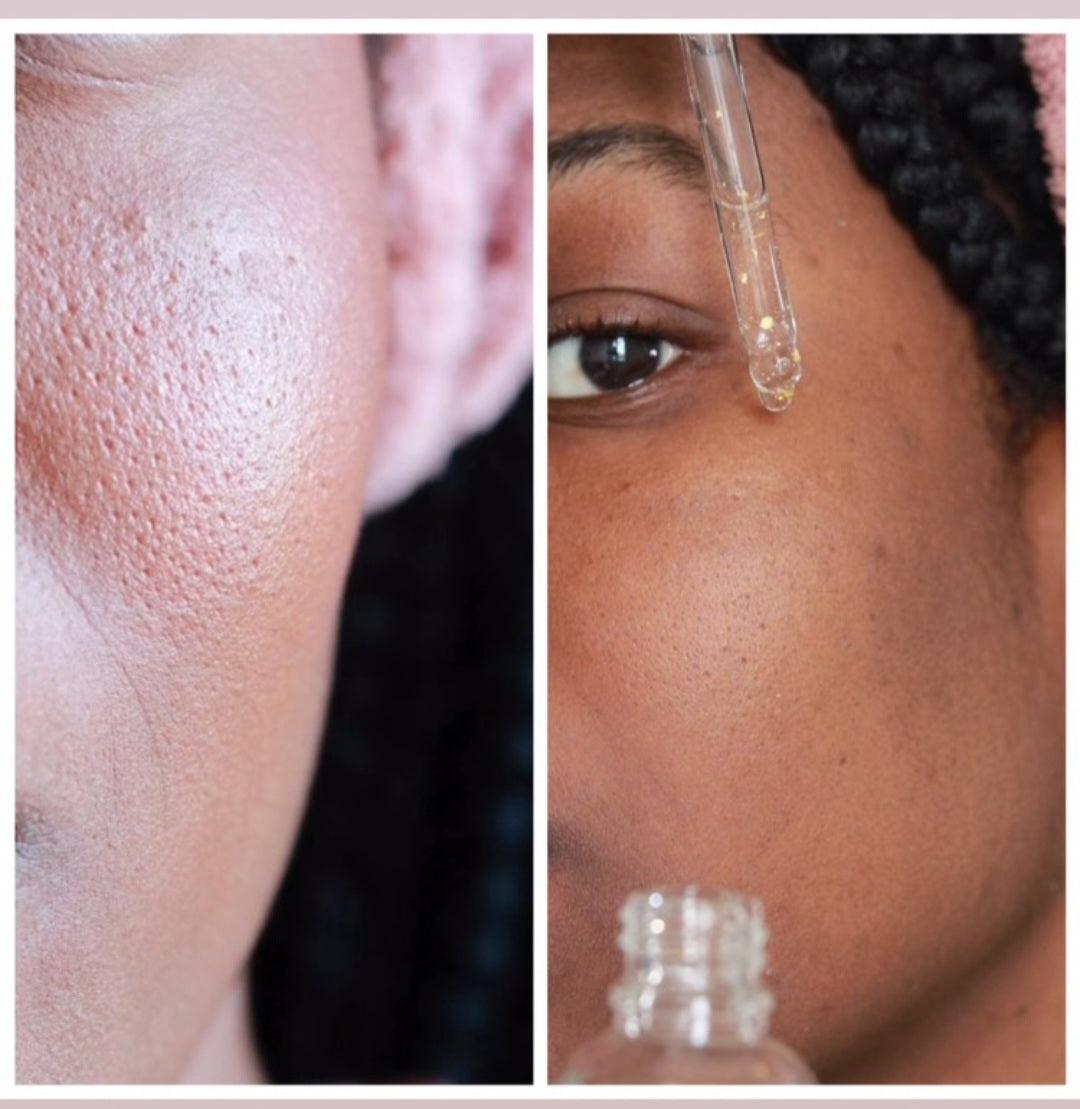 cosmetique peau noire
beau teint
hyperpigmentation
hyperpigmentation peau noire
tâche hyperpigmentation
hyperpigmentation visage
skincare
serum anti tache
serum anti imperfection
serum anti age
serum vitamine C
