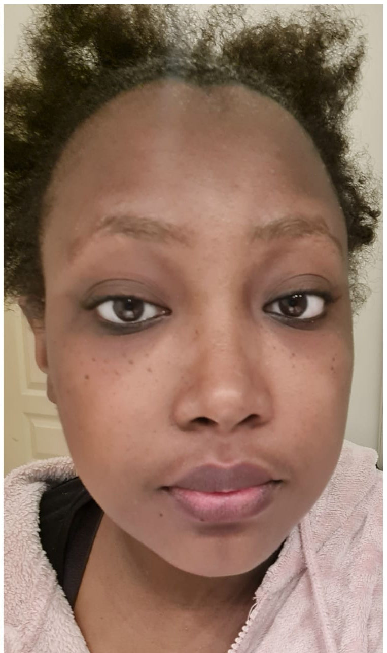 cosmetique peau noire
beau teint
hyperpigmentation
hyperpigmentation peau noire
tâche hyperpigmentation
hyperpigmentation visage
skincare
serum anti tache
serum anti imperfection
serum anti age
serum vitamine C