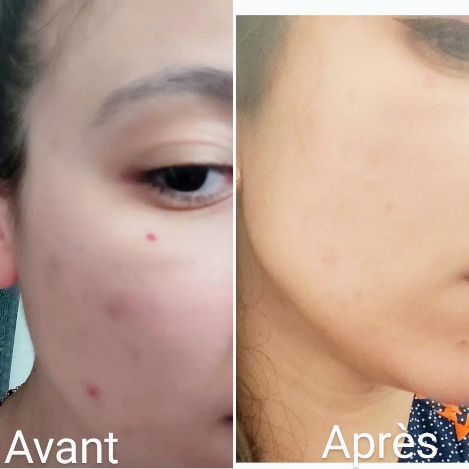 cosmetique
beau teint
hyperpigmentation
tâche hyperpigmentation
hyperpigmentation visage
skincare
serum anti tache
serum anti imperfection
serum anti age
serum vitamine C